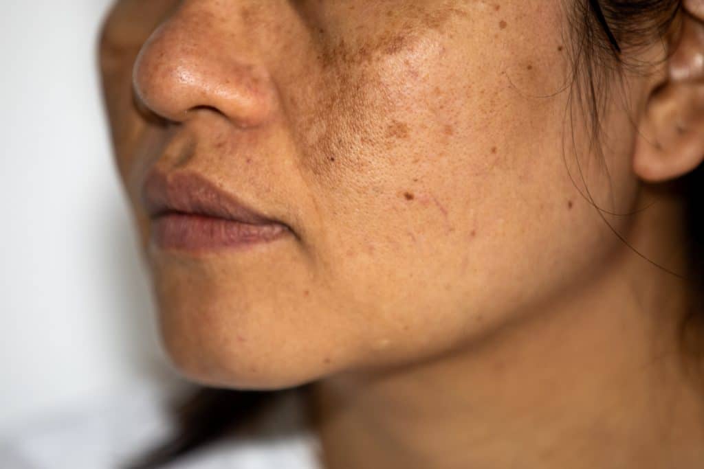 Comment se débarrasser de l’hyperpigmentation ?