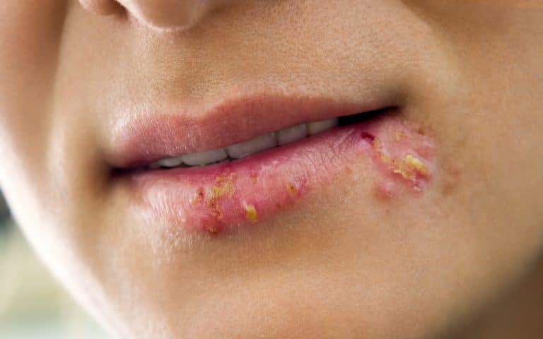 Comment faire disparaître un herpès labial ? Comment faire disparaître un herpès labial ?