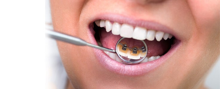 Quel type d’orthodontie choisir lorsqu’on est adulte ?