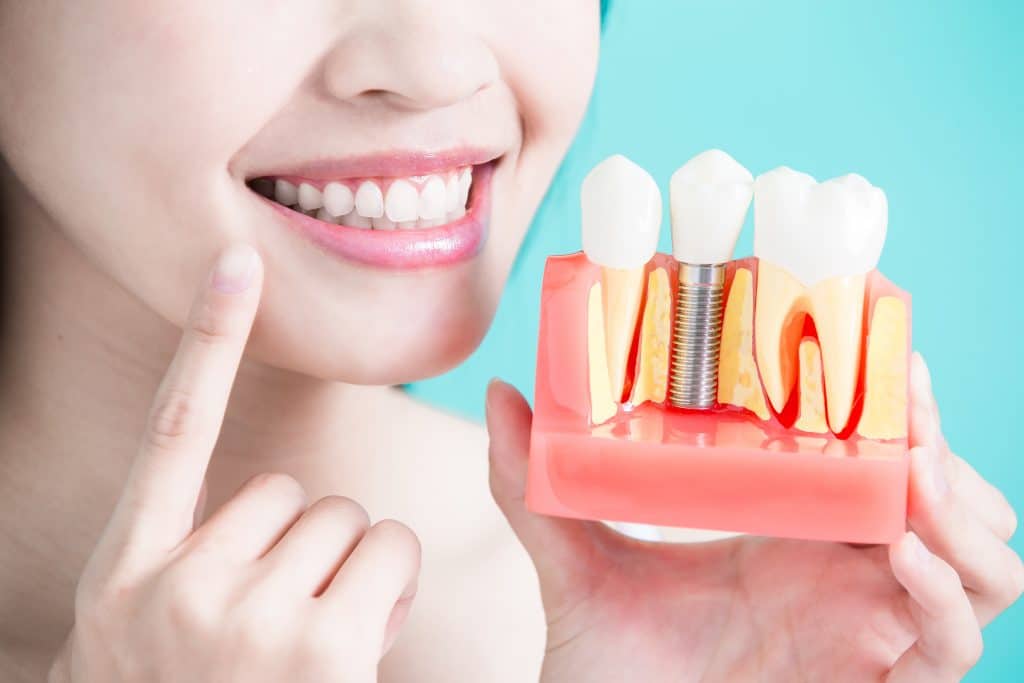 L'implant dentaire : que devez-vous savoir ?