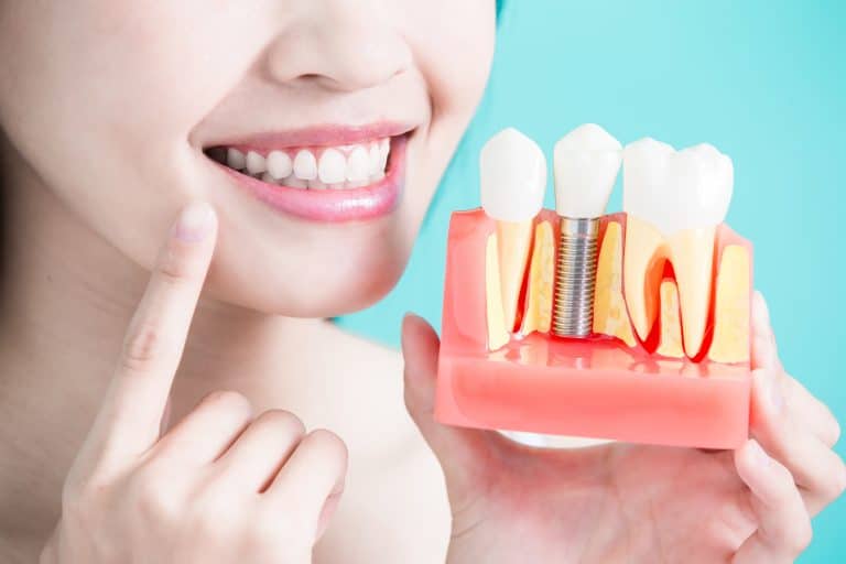 L’implant dentaire : que devez-vous savoir ?