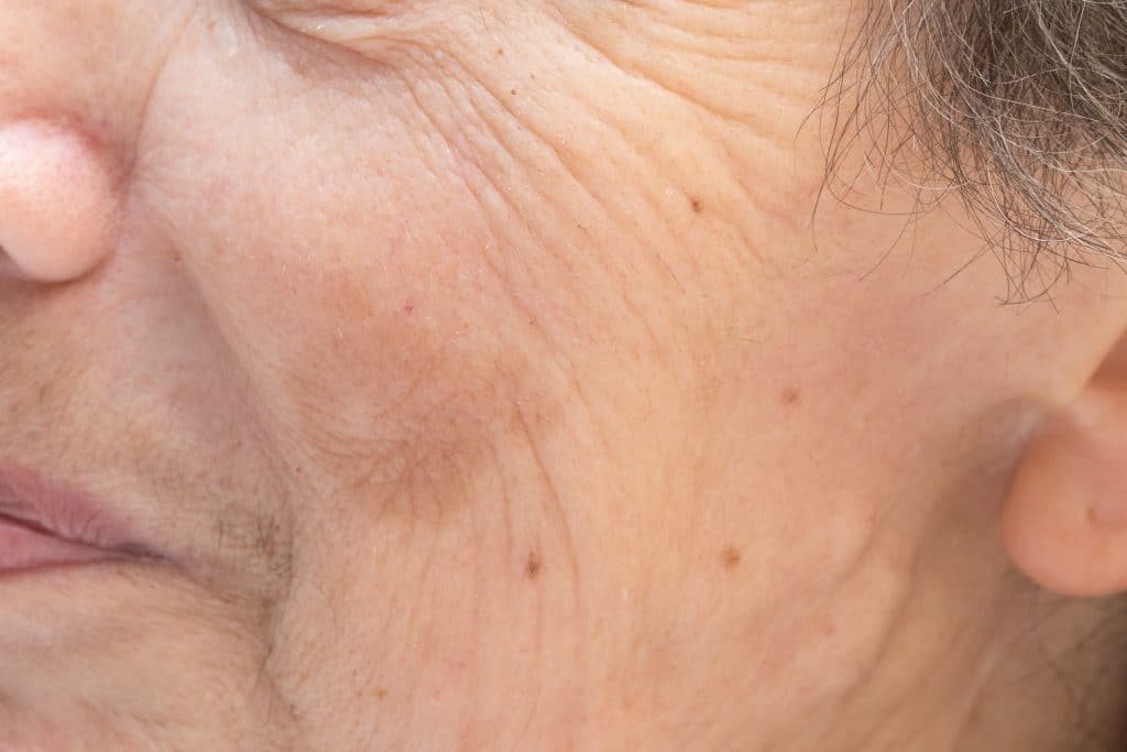 Quels sont les causes des taches brunes sur le visage ?