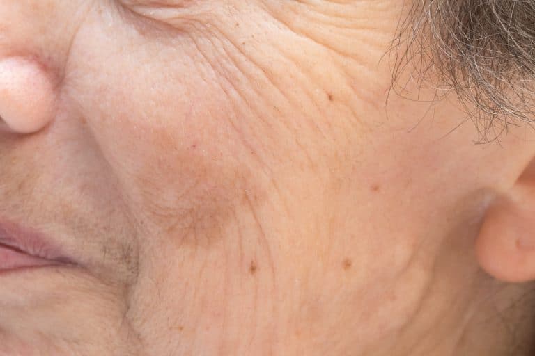 Quels sont les causes des taches brunes sur le visage ? Quels sont les causes des taches brunes sur le visage ?