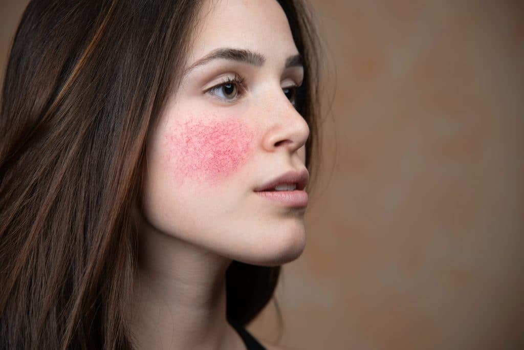 Qu’est-ce que l’acné rosacée ?