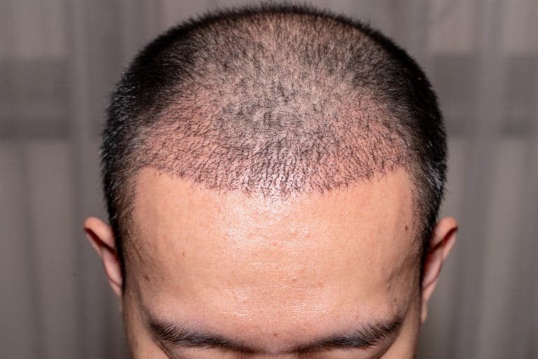Greffe de cheveux : que faut-il savoir ? Greffe de cheveux : que faut-il savoir ?