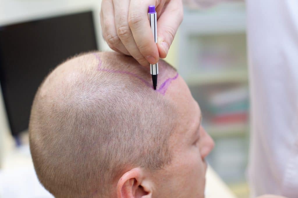 La greffe de cheveux : pour qui ?