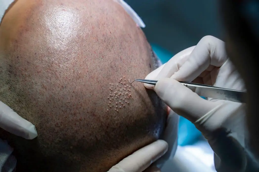 Comment se déroule une greffe de cheveux ?