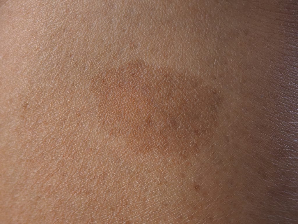 Comment se débarrasser de l'hyperpigmentation ?