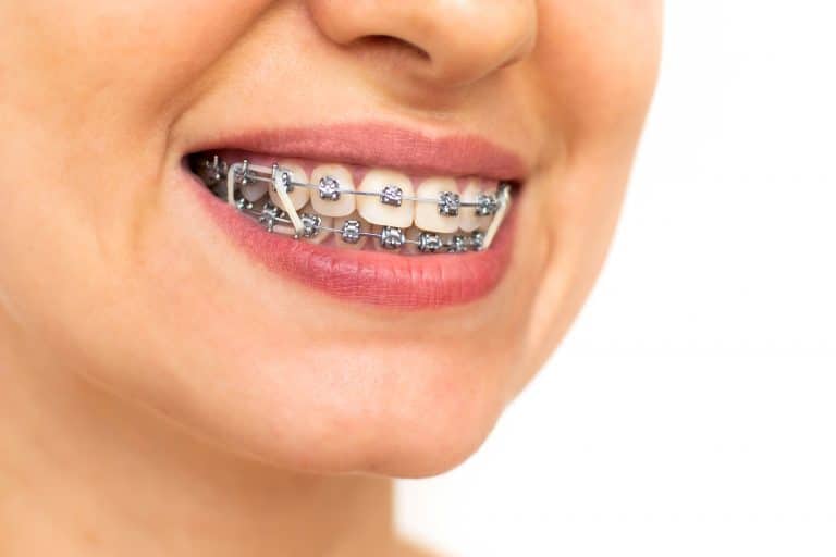 Orthodontie pour adulte : les garanties des assurances