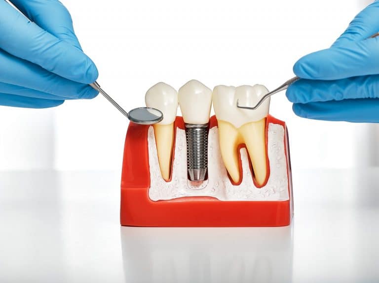 L’implant dentaire : combien ça coûte ?