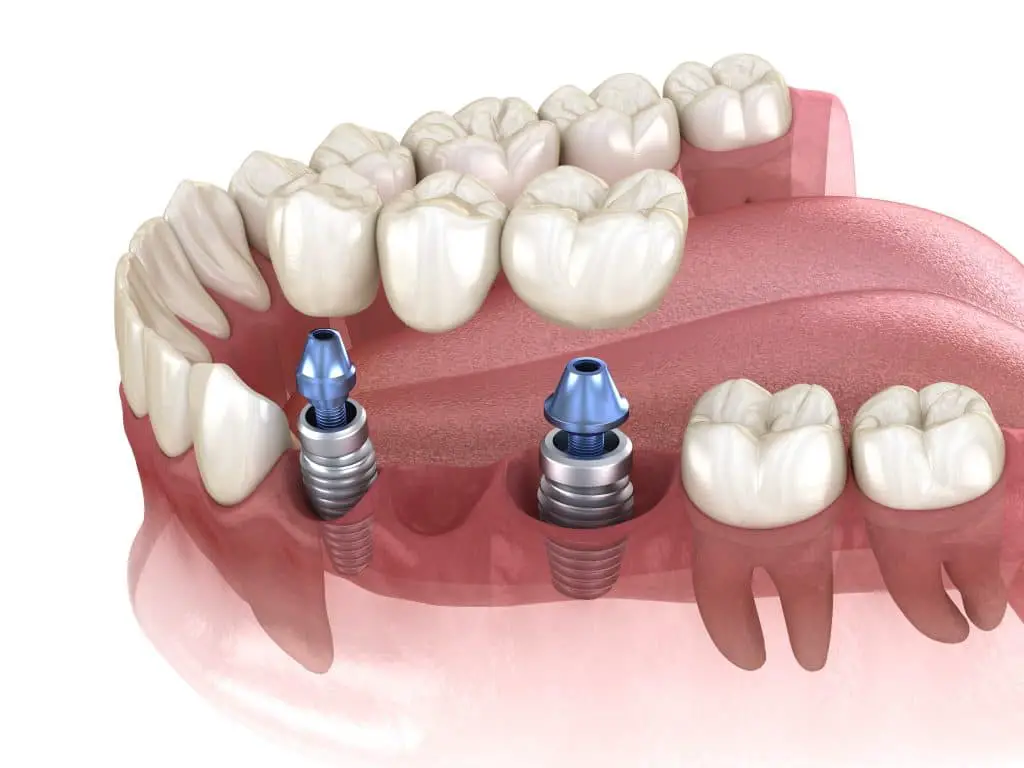 Quel est le prix d'un implant dentaire ?