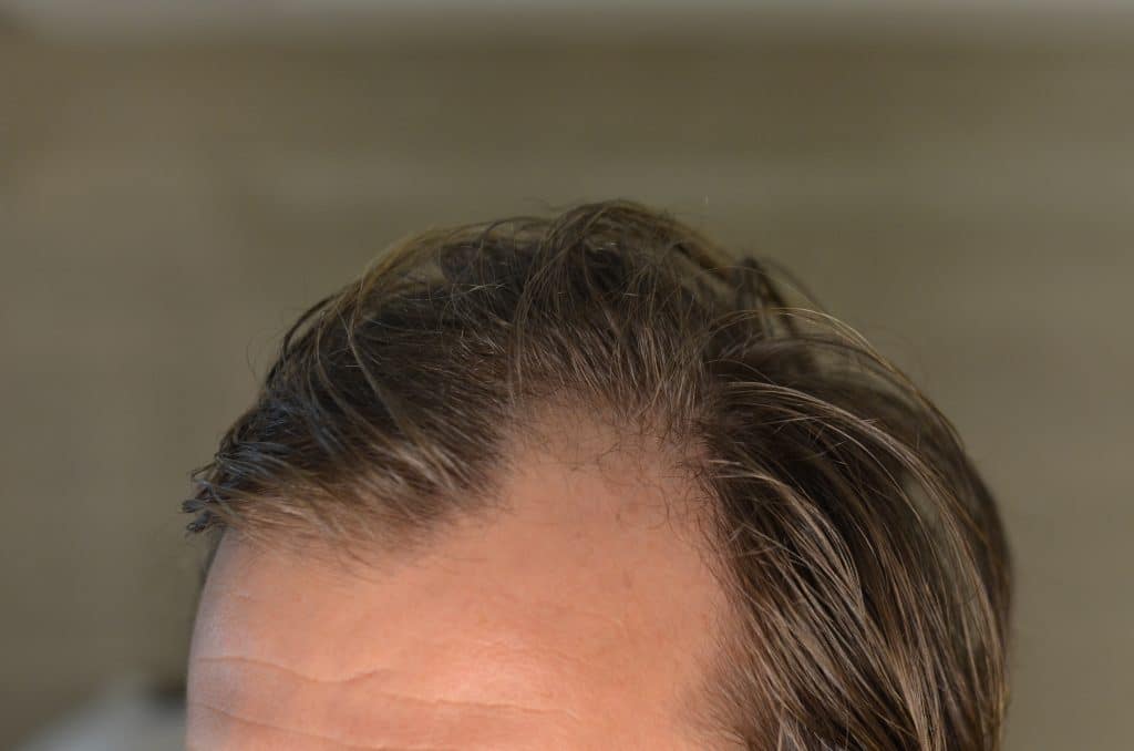 Début de calvitie : comment réagir ?