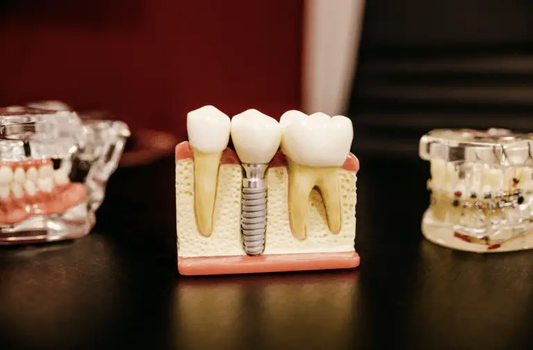 Implant dentaire : quel est le bon moment pour consulter ?