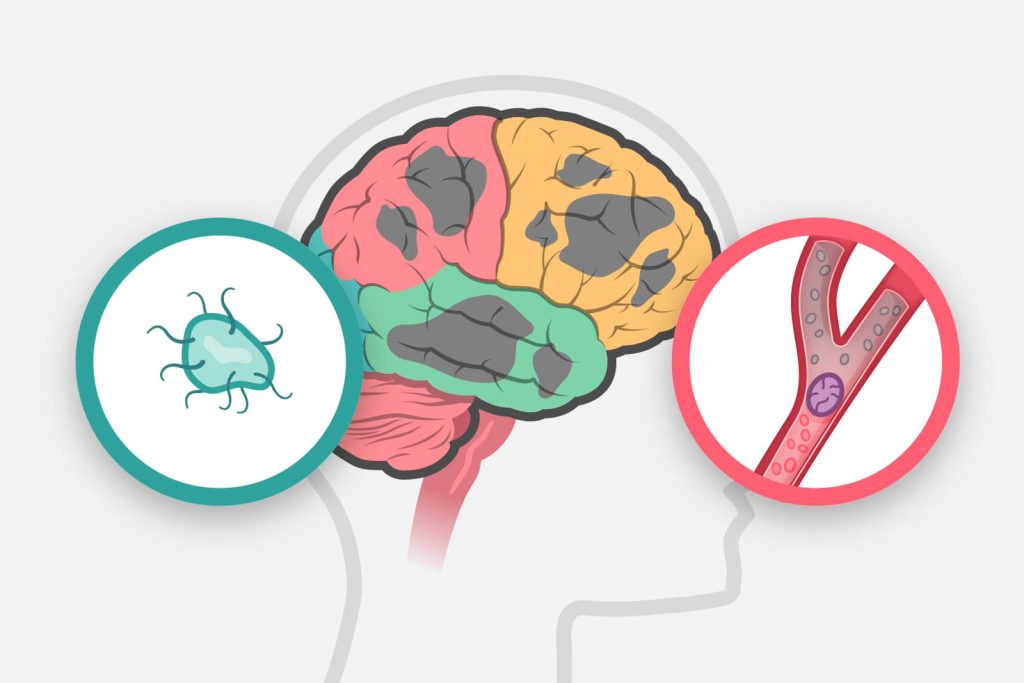 démence santé vasculaire